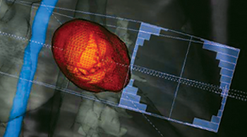 VignetteSite_ISOgray_dose distribution_zoom