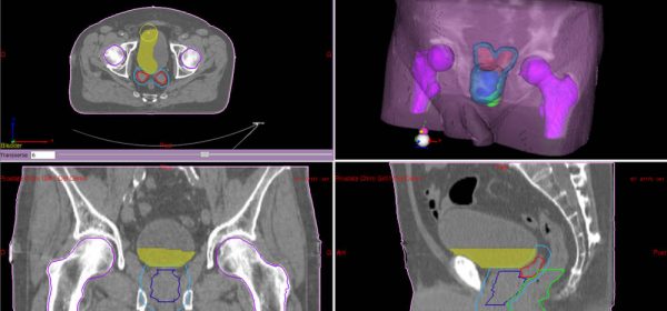 pelvis_bladd_brush_resized